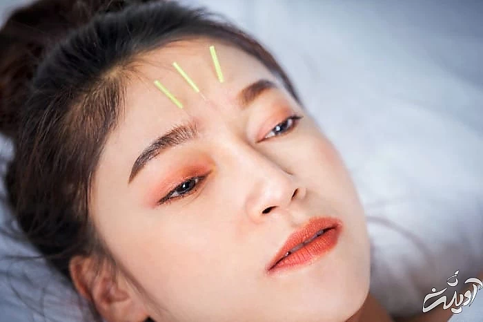 طب سوزنی صورت